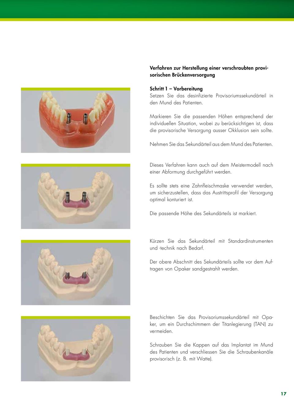 Nehmen Sie das Sekundärteil aus dem Mund des Patienten. Dieses Verfahren kann auch auf dem Meistermodell nach einer Abformung durchgeführt werden.