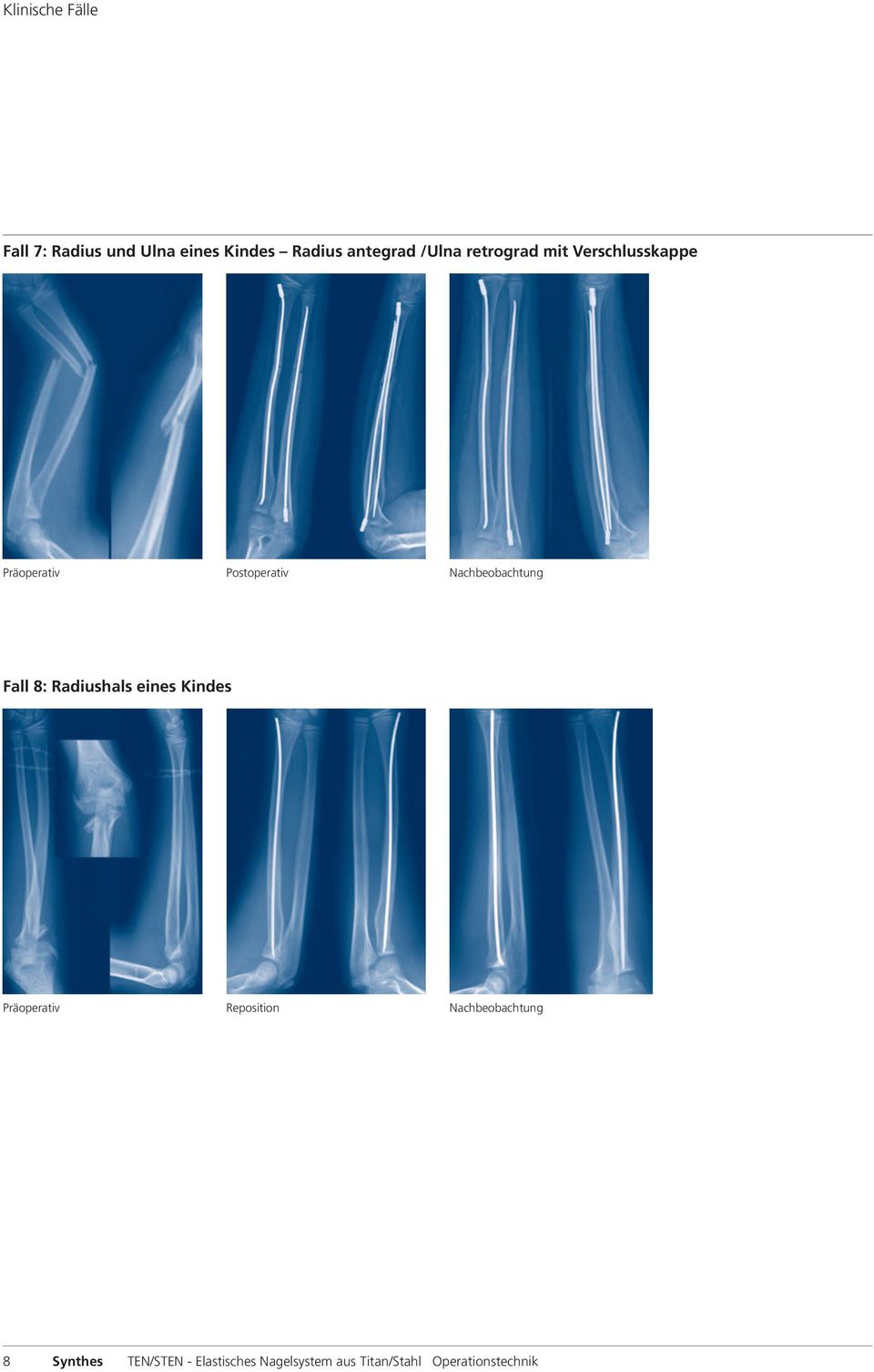 Nachbeobachtung Fall 8: Radiushals eines Kindes Präoperativ Reposition