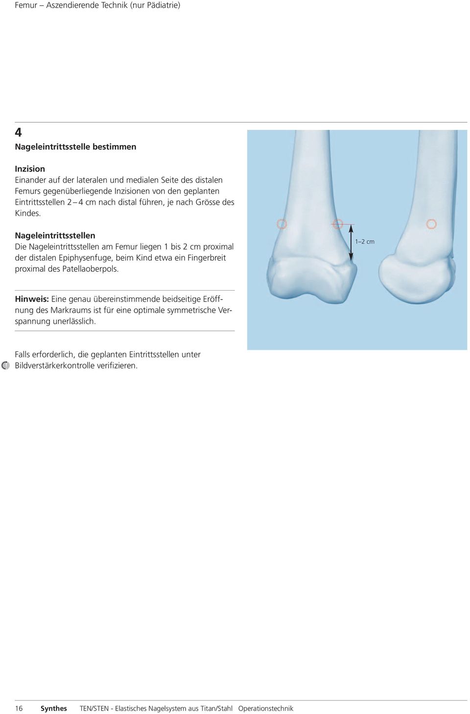 Nageleintrittsstellen Die Nageleintrittsstellen am Femur liegen 1 bis 2 cm proximal der distalen Epiphysenfuge, beim Kind etwa ein Fingerbreit proximal des Patellaoberpols.