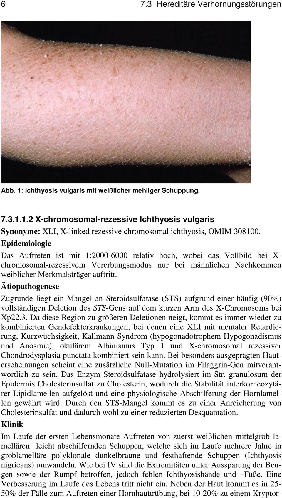 Zugrunde liegt ein Mangel an Steroidsulfatase (STS) aufgrund einer häufig (90%) vollständigen Deletion des STS-Gens auf dem kurzen Arm des X-Chromosoms bei Xp22.3.