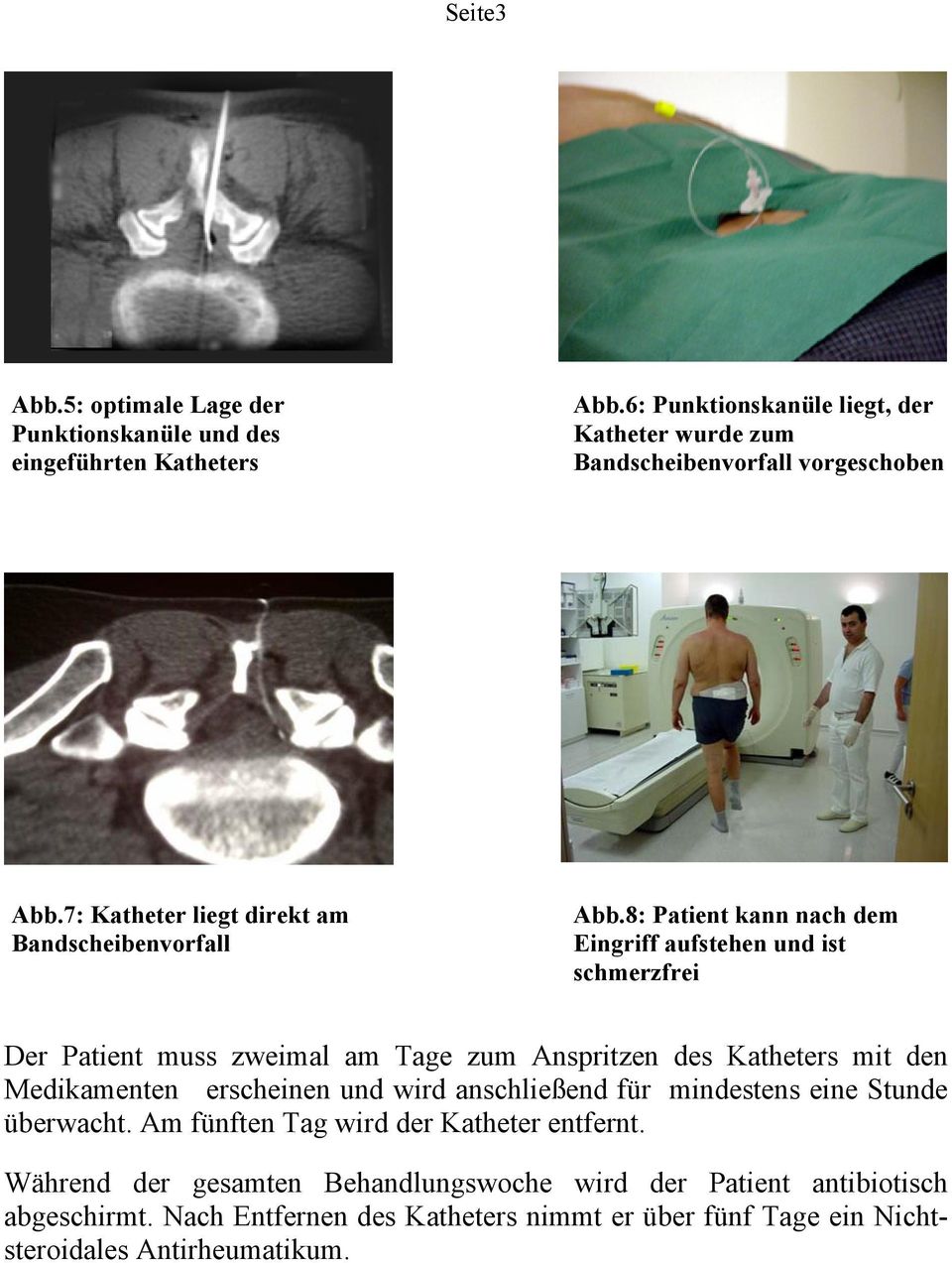 8: Patient kann nach dem Eingriff aufstehen und ist schmerzfrei Der Patient muss zweimal am Tage zum Anspritzen des Katheters mit den Medikamenten erscheinen und