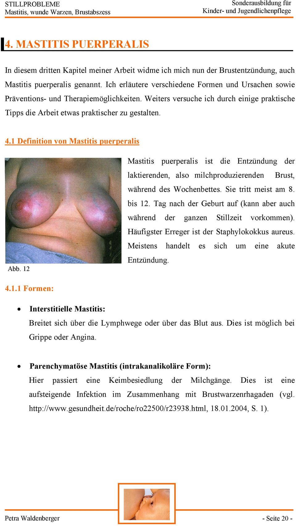 1 Definition von Mastitis puerperalis Abb. 12 Mastitis puerperalis ist die Entzündung der laktierenden, also milchproduzierenden Brust, während des Wochenbettes. Sie tritt meist am 8. bis 12.