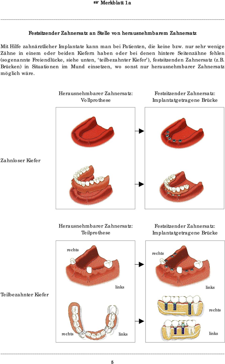festsitzenden Zahnersatz (z.b. Brücken) in Situationen im Mund einsetzen, wo sonst nur herausnehmbarer Zahnersatz möglich wäre.