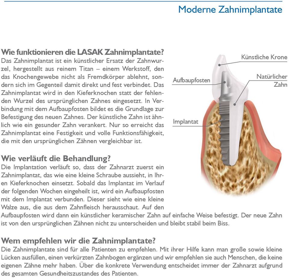 und fest verbindet. Das Zahn implantat wird in den Kieferknochen statt der fehlenden Wurzel des ursprünglichen Zahnes eingesetzt.