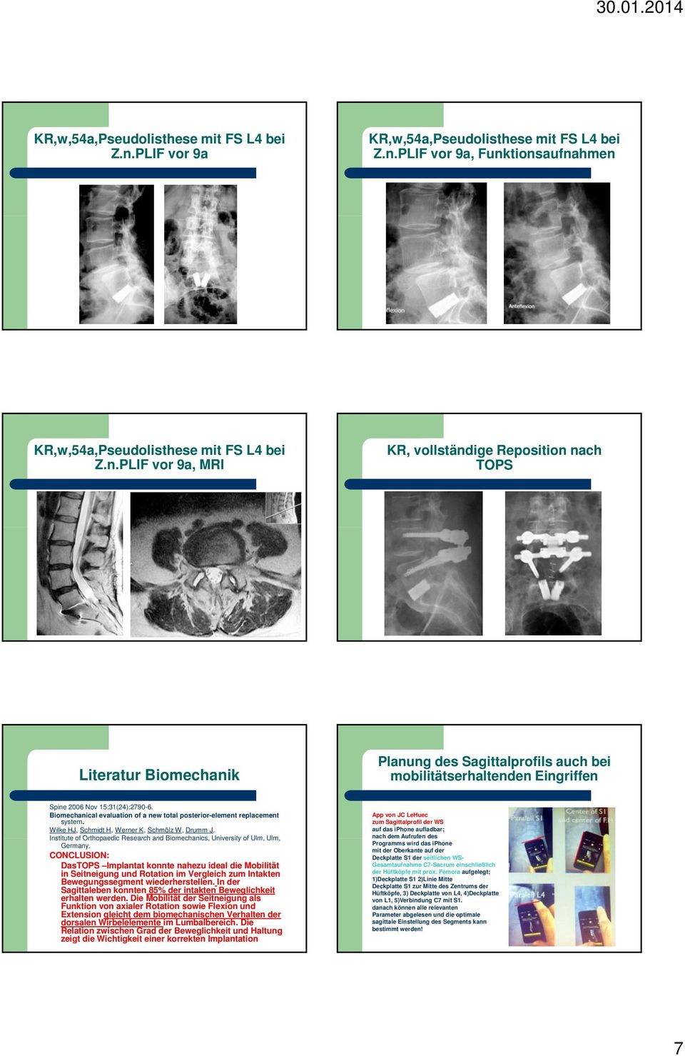 2006 Nov 15;31(24):2790-6. Biomechanical evaluation of a new total posterior-element replacement system. Wilke HJ, Schmidt H, Werner K, Schmölz W, Drumm J.