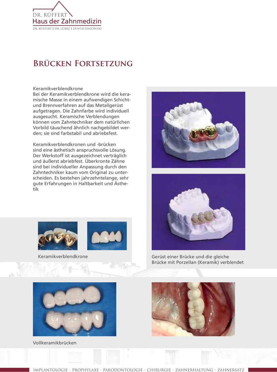 Keramikverblendkronen und -brücken sind eine ästhetisch anspruchsvolle Lösung. Der Werkstoff ist ausgezeichnet verträglich und äußerst abriebfest.