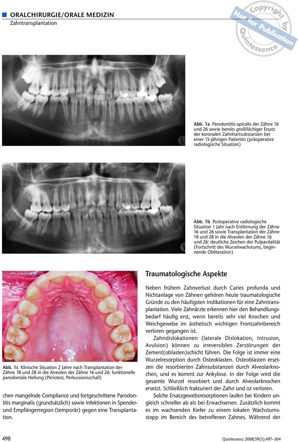 1b Postoperative radiologische Situation 1 Jahr nach Entfernung der Zähne 16 und 26 sowie Transplantation der Zähne 18 und 28 in die Alveolen der Zähne 16 und 26: deutliche Zeichen der Pulpavitalität