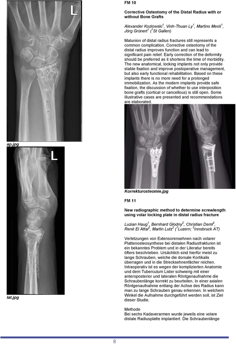 Early correction of the deformity should be preferred as it shortens the time of morbidity.