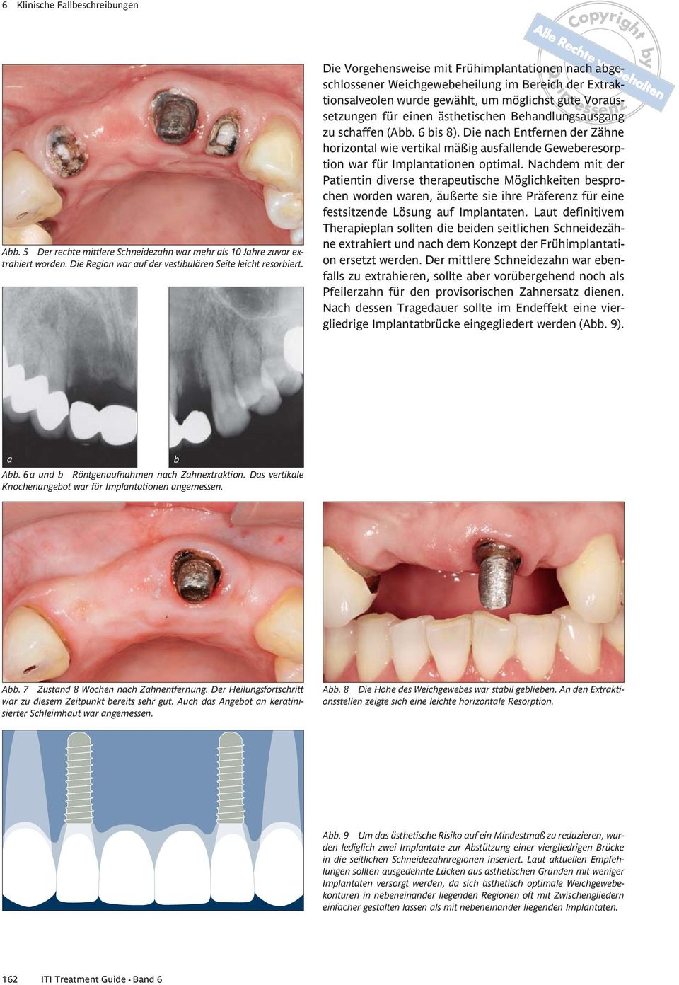Behandlungsausgang zu schaffen (Abb. 6 bis 8). Die nach Entfernen der Zähne horizontal wie vertikal mäßig ausfallende Geweberesorption war für Implantationen optimal.