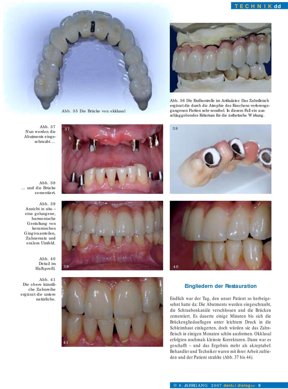 37 Nun werden die Abutments eingeschraubt 37 38 Abb. 38 und die Brücke zementiert. Abb. 39 Ansicht in situ eine gelungene, harmonische Gestaltung von keramischen Gingivaanteilen, Zahnersatz und oralem Umfeld.