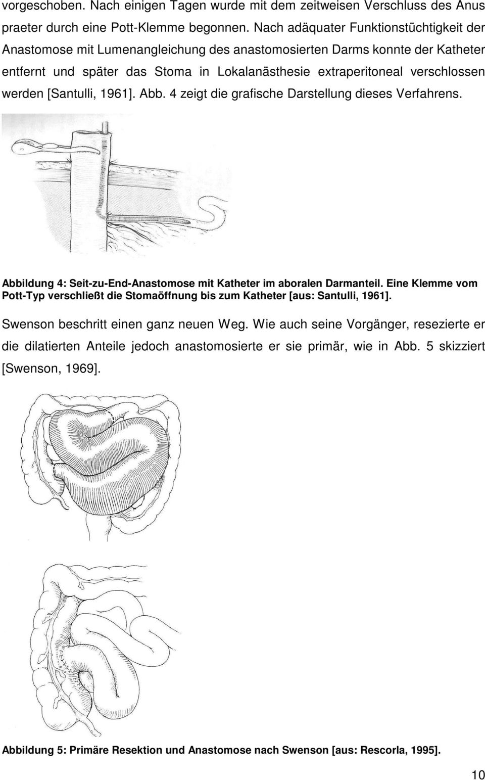 werden [Santulli, 1961]. Abb. 4 zeigt die grafische Darstellung dieses Verfahrens. Abbildung 4: Seit-zu-End-Anastomose mit Katheter im aboralen Darmanteil.