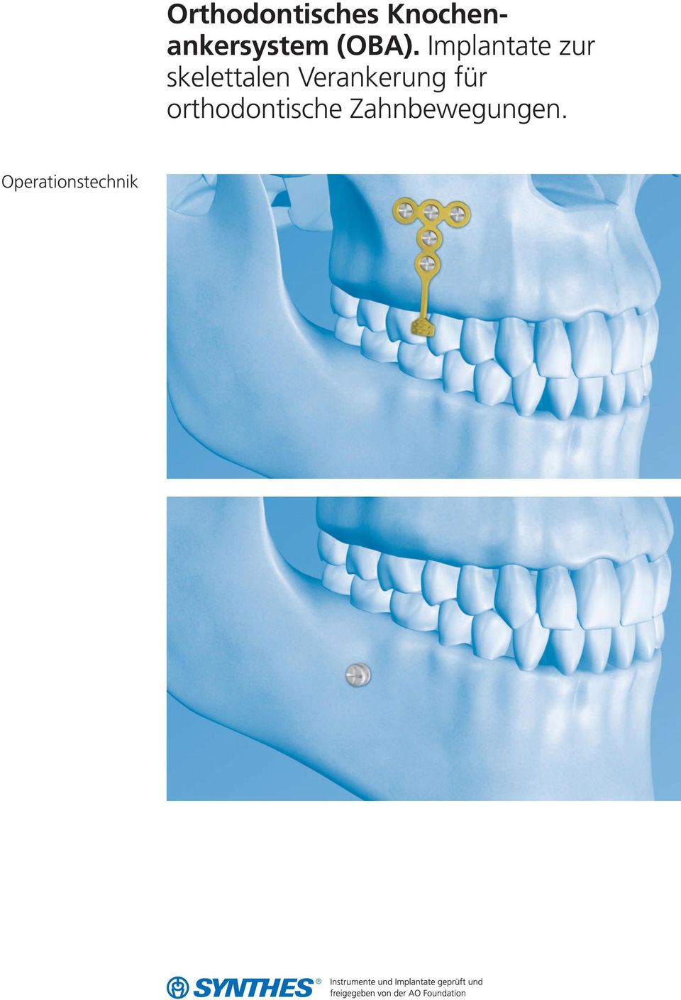 Implantate zur skelettalen