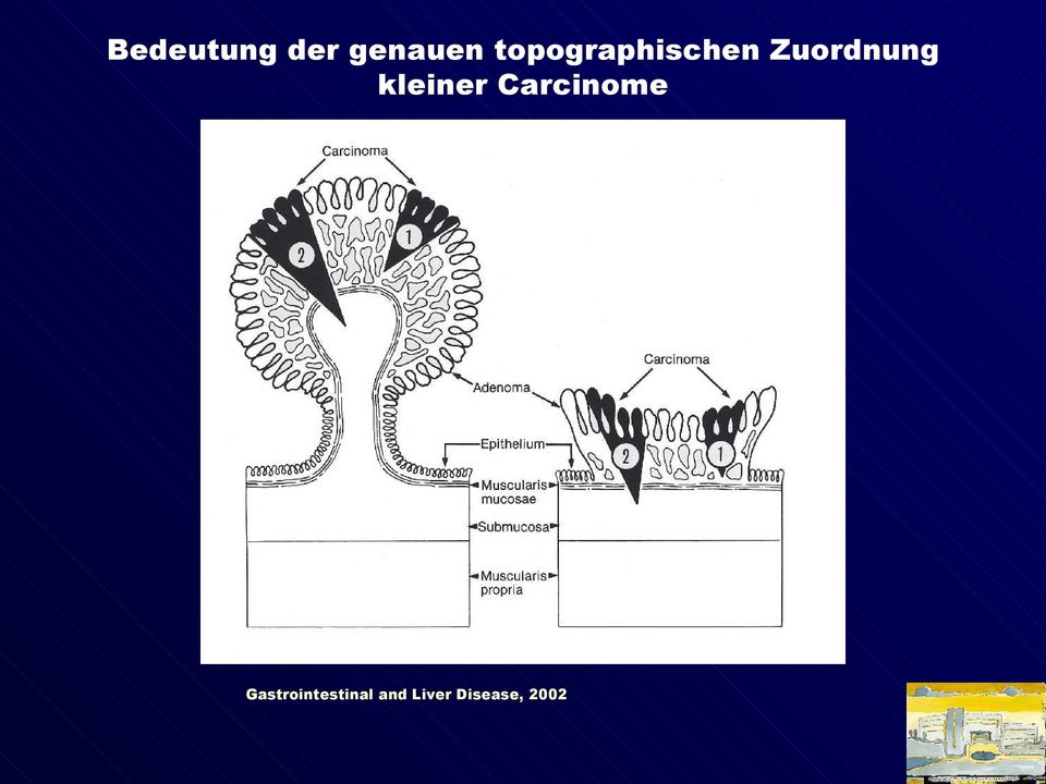 kleiner Carcinome