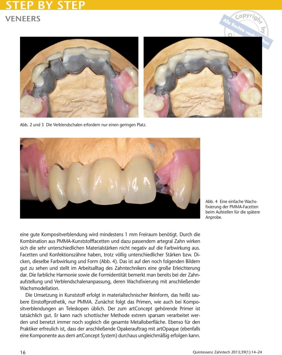 Durch die Kombination aus PMMA-Kunststofffacetten und dazu passendem artegral Zahn wirken sich die sehr unterschiedlichen Materialstärken nicht negativ auf die Farbwirkung aus.
