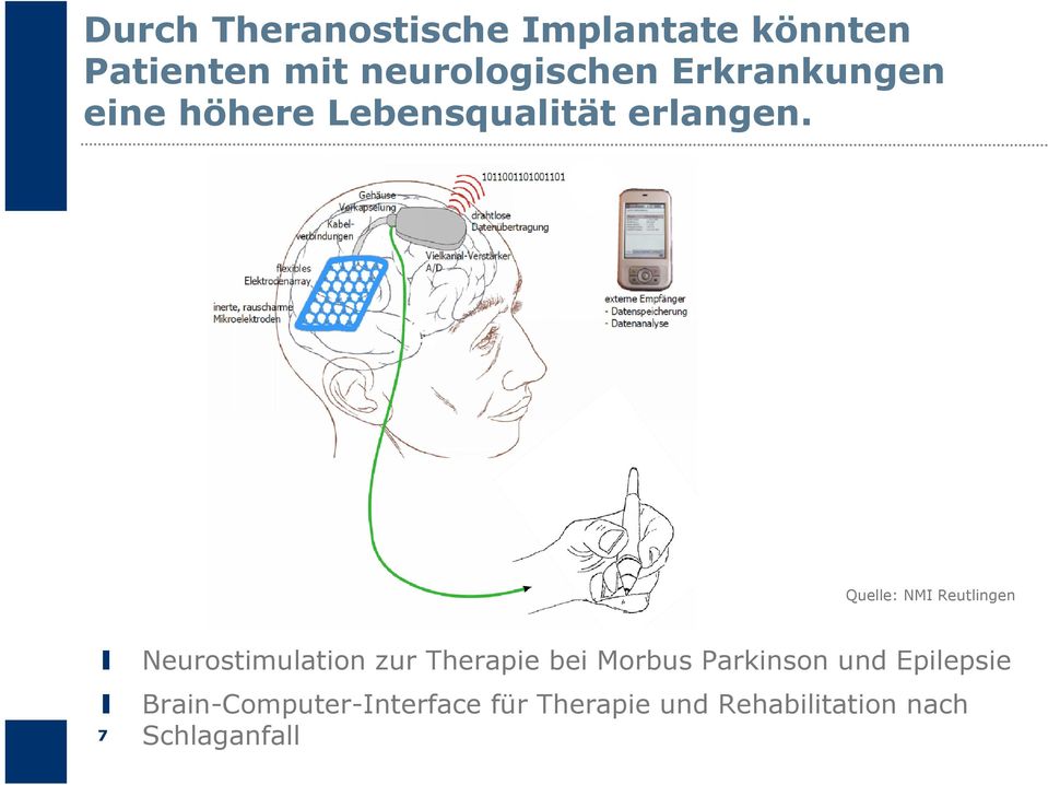Quelle: NMI Reutlingen 7 Neurostimulation zur Therapie bei Morbus