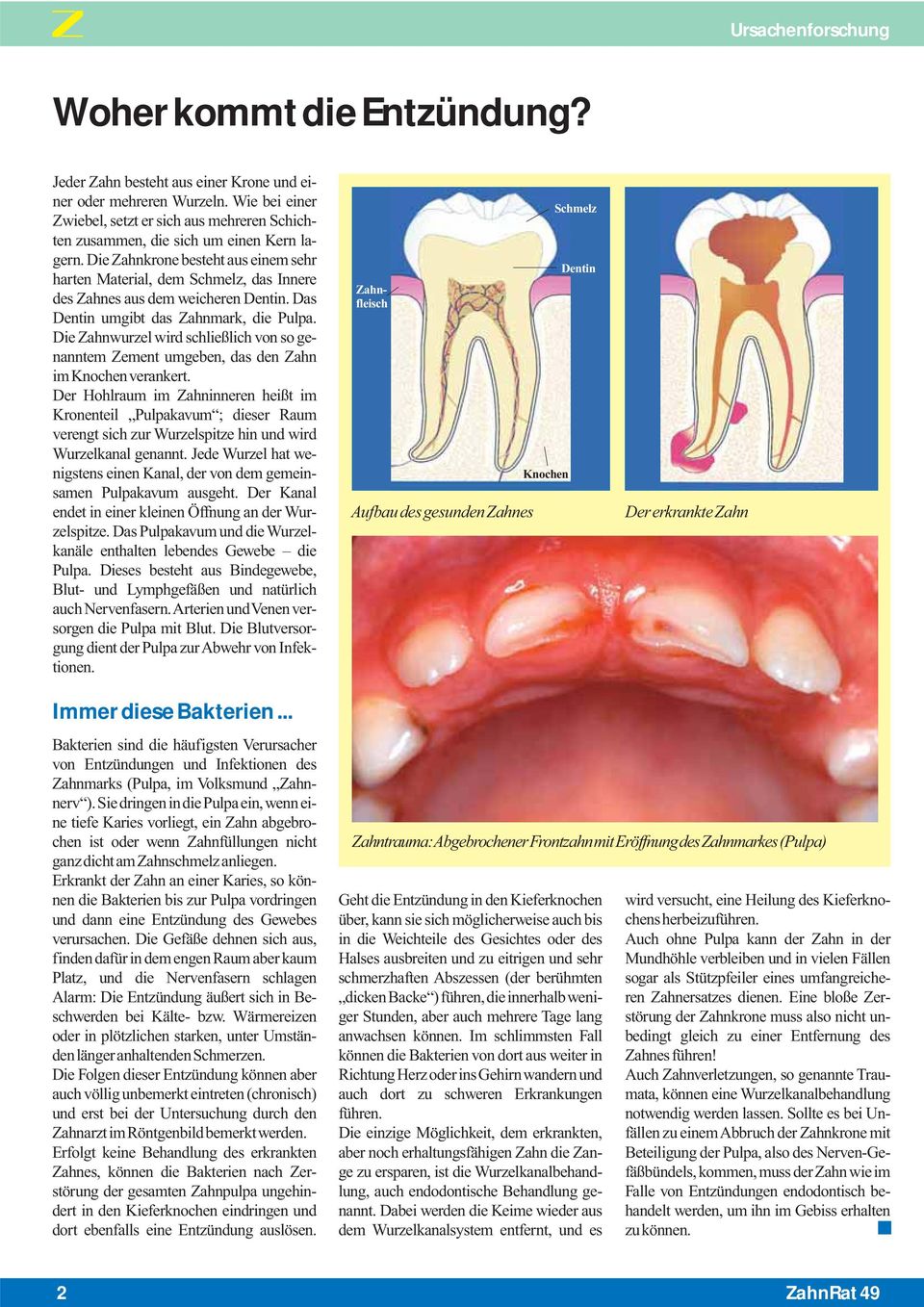 Die Zahnkrone besteht aus einem sehr harten Material, dem Schmelz, das Innere des Zahnes aus dem weicheren Dentin. Das Dentin umgibt das Zahnmark, die Pulpa.