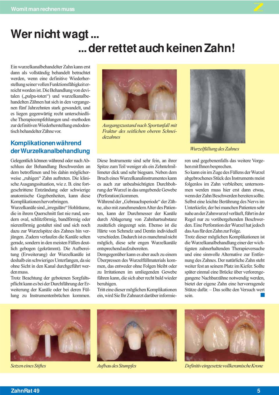 Die Behandlung von devitalen ( pulpa-toten ) und wurzelkanalbehandelten Zähnen hat sich in den vergangenen fünf Jahrzehnten stark gewandelt, und es liegen gegenwärtig recht unterschiedliche