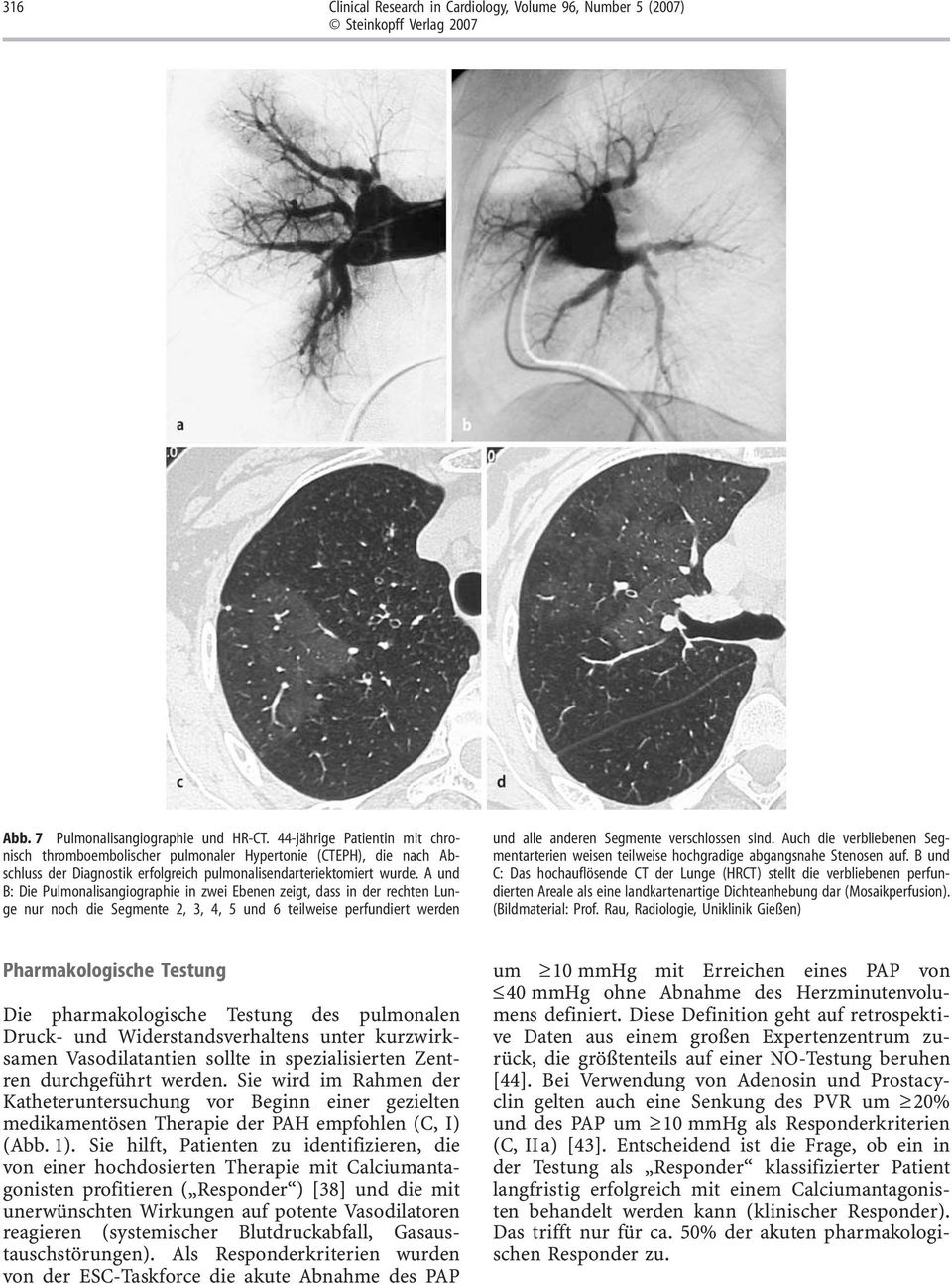 A und B: Die Pulmonalisangiographie in zwei Ebenen zeigt, dass in der rechten Lunge nur noch die Segmente 2, 3, 4, 5 und 6 teilweise perfundiert werden und alle anderen Segmente verschlossen sind.