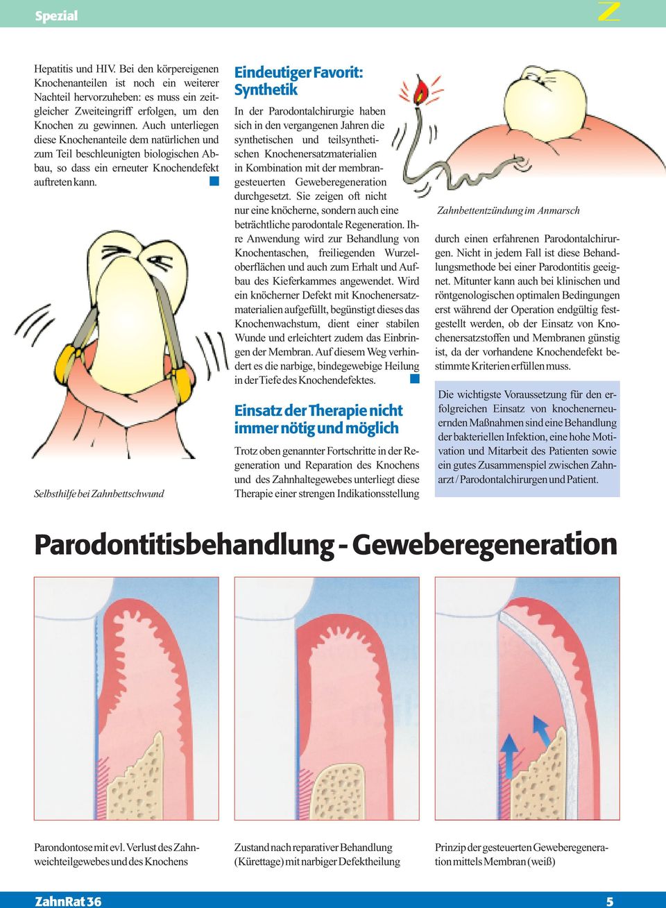 Selbsthilfe bei Zahnbettschwund Eindeutiger Favorit: Synthetik In der Parodontalchirurgie haben sich in den vergangenen Jahren die synthetischen und teilsynthetischen Knochenersatzmaterialien in