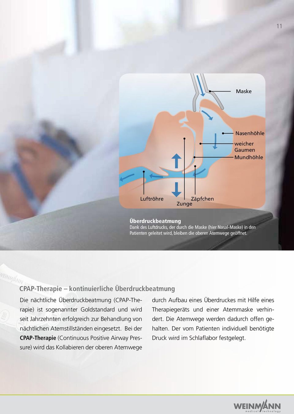 CPAP-Therapie kontinuierliche Überdruckbeatmung Die nächtliche Überdruckbeatmung (CPAP-Therapie) ist sogenannter Goldstandard und wird seit Jahrzehnten erfolgreich zur Behandlung von