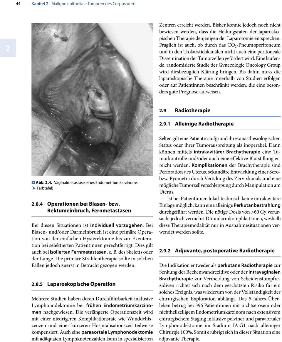 Fraglich ist auch, ob durch das CO -Pneumoperitoneum und in den Trokarstichkanälen nicht auch eine peritoneale Dissemination der Tumorzellen gefördert wird.