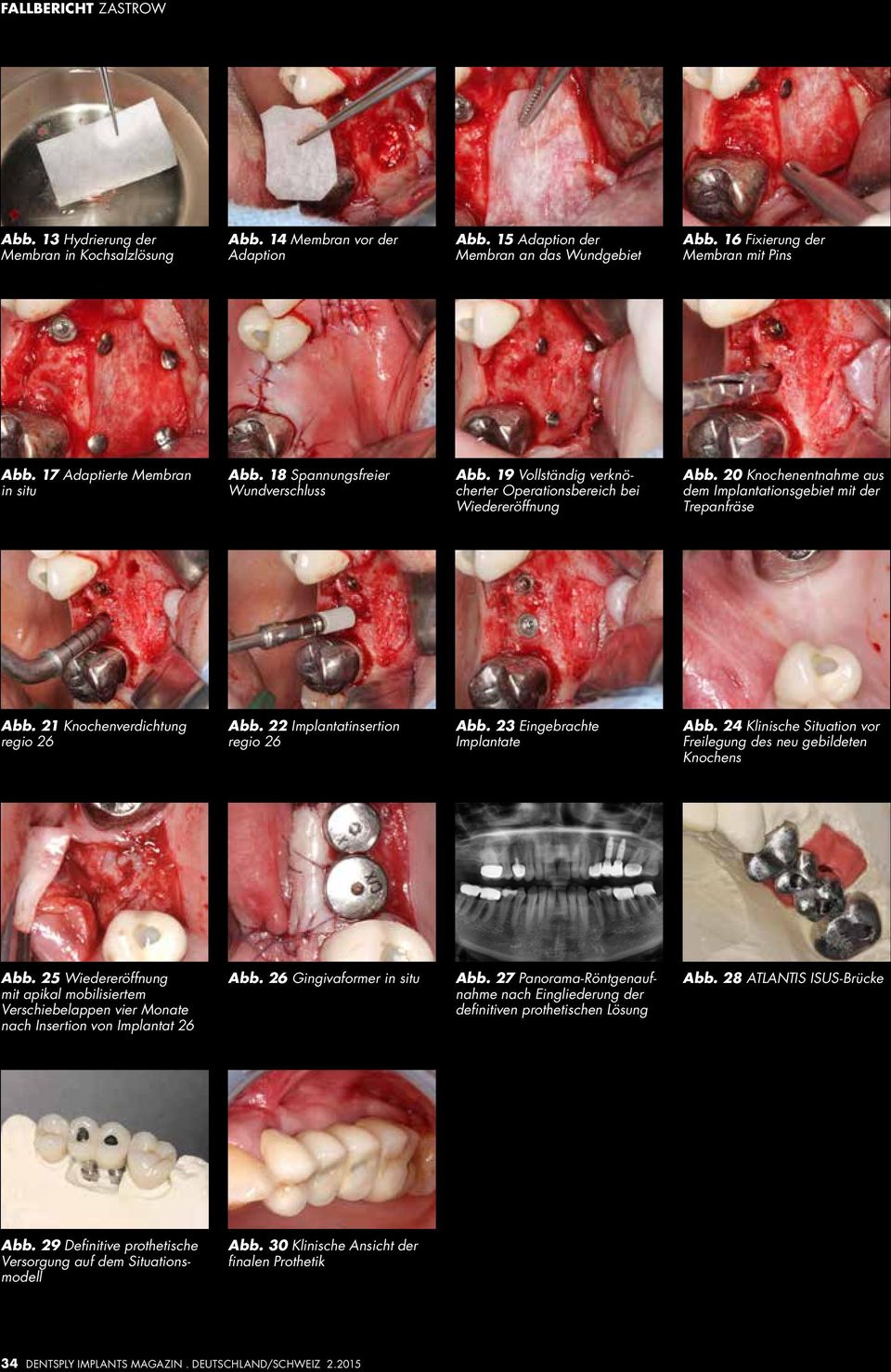 20 Knochenentnahme aus dem Implantationsgebiet mit der Trepanfräse Abb. 21 Knochenverdichtung regio 26 Abb. 22 Implantatinsertion regio 26 Abb. 23 Eingebrachte Implantate Abb.