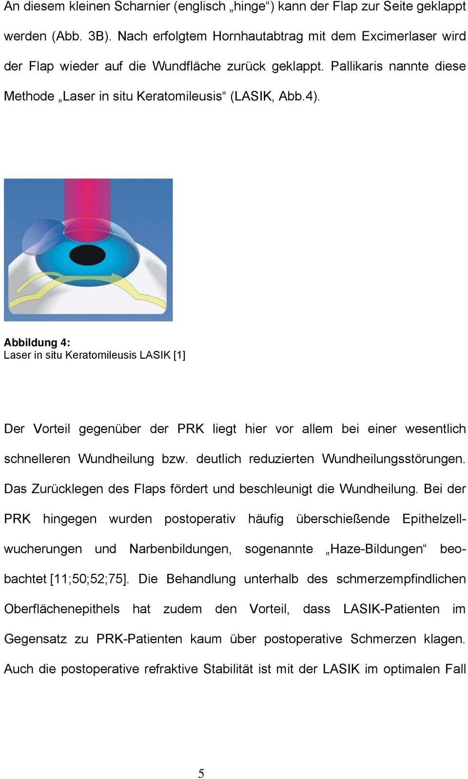 Abbildung 4: Laser in situ Keratomileusis LASIK [1] Der Vorteil gegenüber der PRK liegt hier vor allem bei einer wesentlich schnelleren Wundheilung bzw. deutlich reduzierten Wundheilungsstörungen.