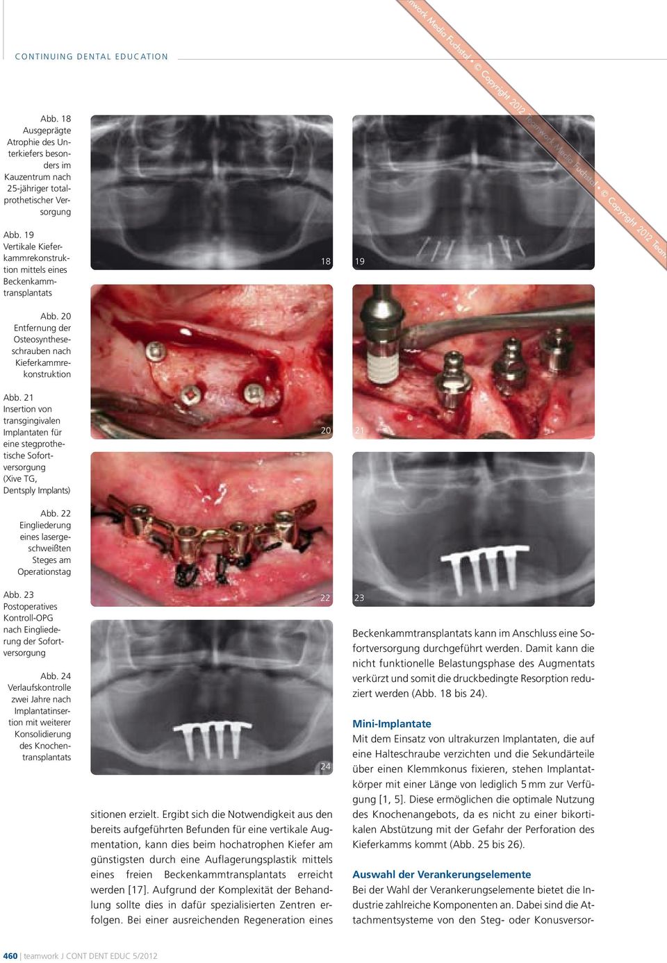 21 Insertion von transgingivalen Implantaten für eine stegprothe - tische Sofort - versorgung (Xive TG, Dentsply Implants) 20 21 Abb.