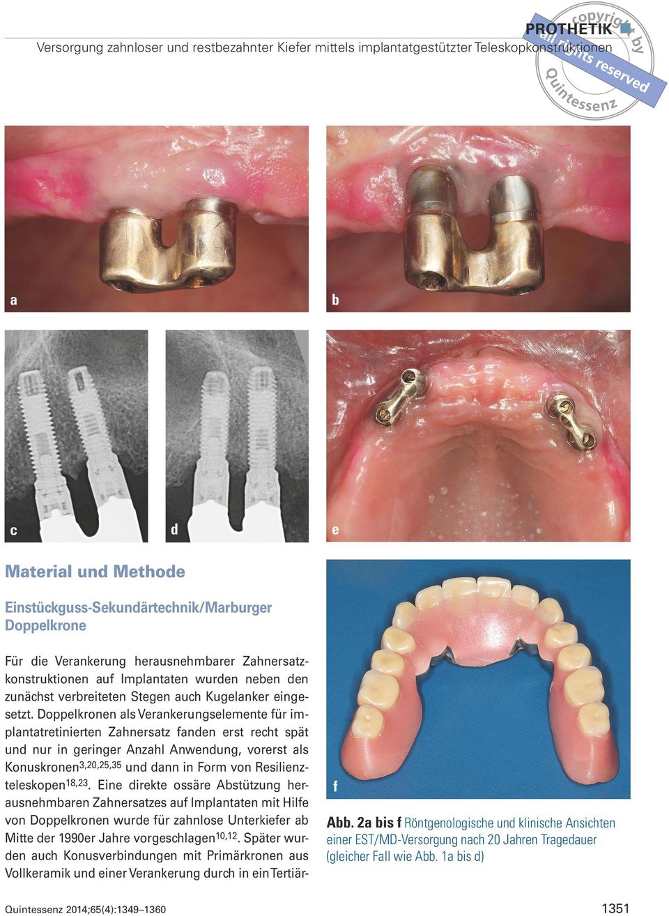 Doppelkronen als Verankerungselemente für implantatretinierten Zahnersatz fanden erst recht spät und nur in geringer Anzahl Anwendung, vorerst als Konuskronen3,20,25,35 und dann in Form von