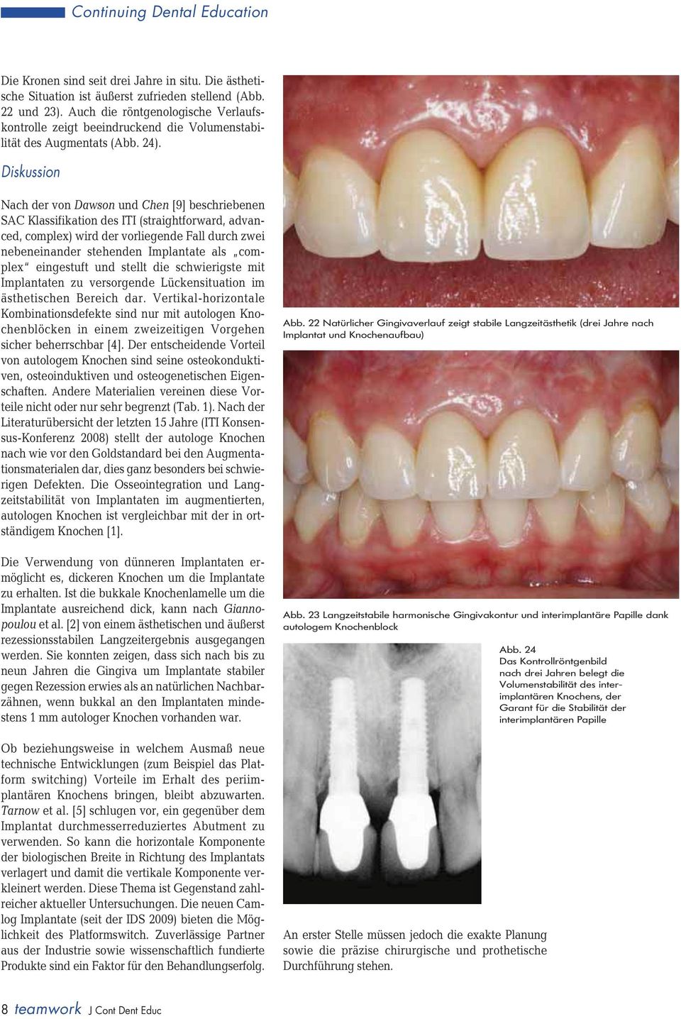 Diskussion Nach der von Dawson und Chen [9] beschriebenen SAC Klassifikation des ITI (straightforward, advanced, complex) wird der vorliegende Fall durch zwei nebeneinander stehenden Implantate als