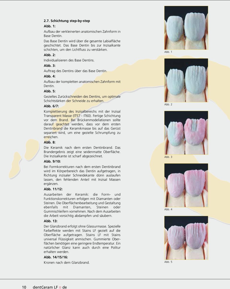 Abb. 5: Gezieltes Zurückschneiden des Dentins, um optimale Schichtstärken der Schneide zu erhalten. Abb. 6/7: Komplettierung des Inzisalbereichs mit der Inzisal Transparent Masse (IT57 - IT60).