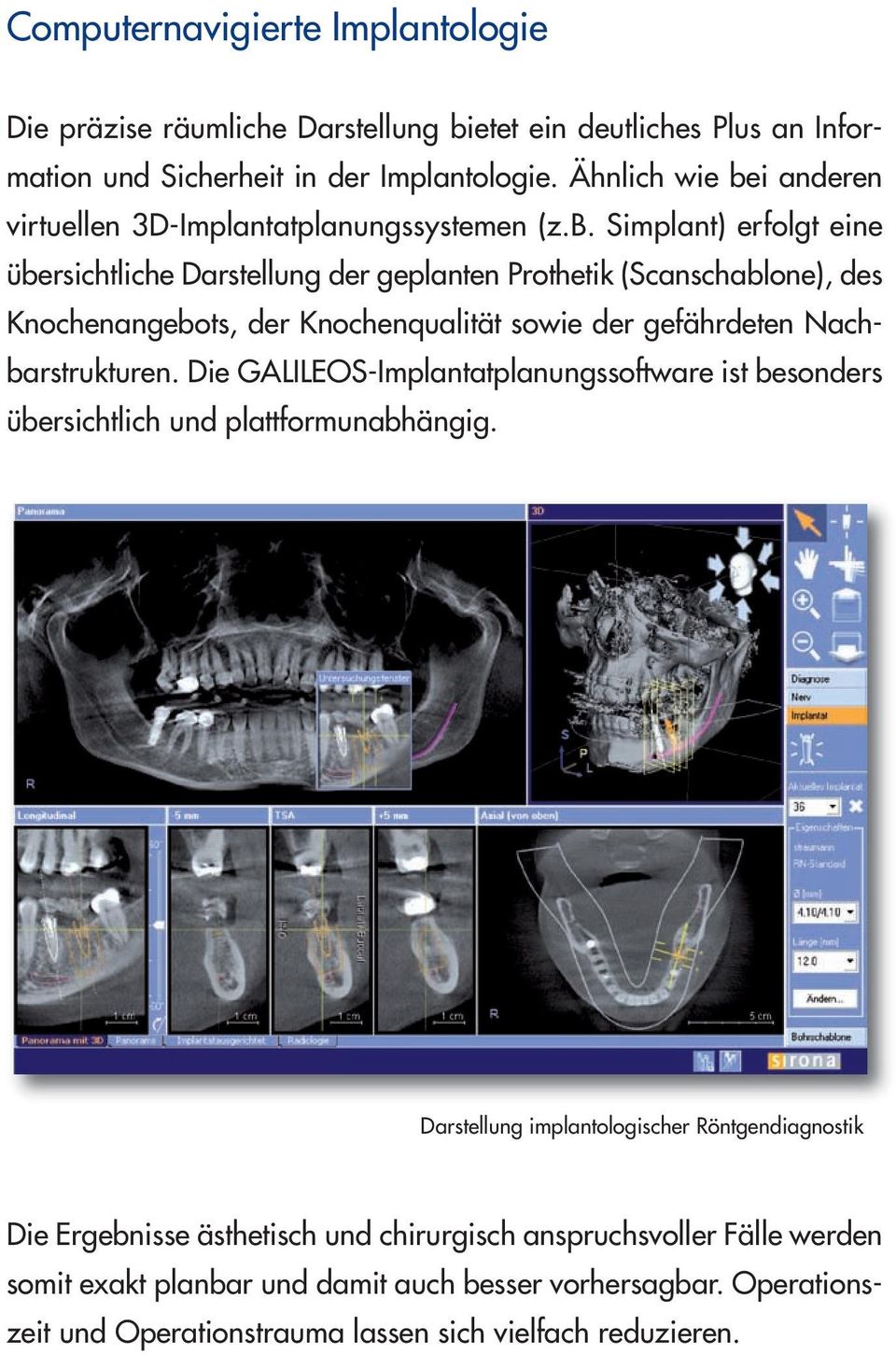 i anderen virtuellen 3D-Implantatplanungssystemen (z.b.