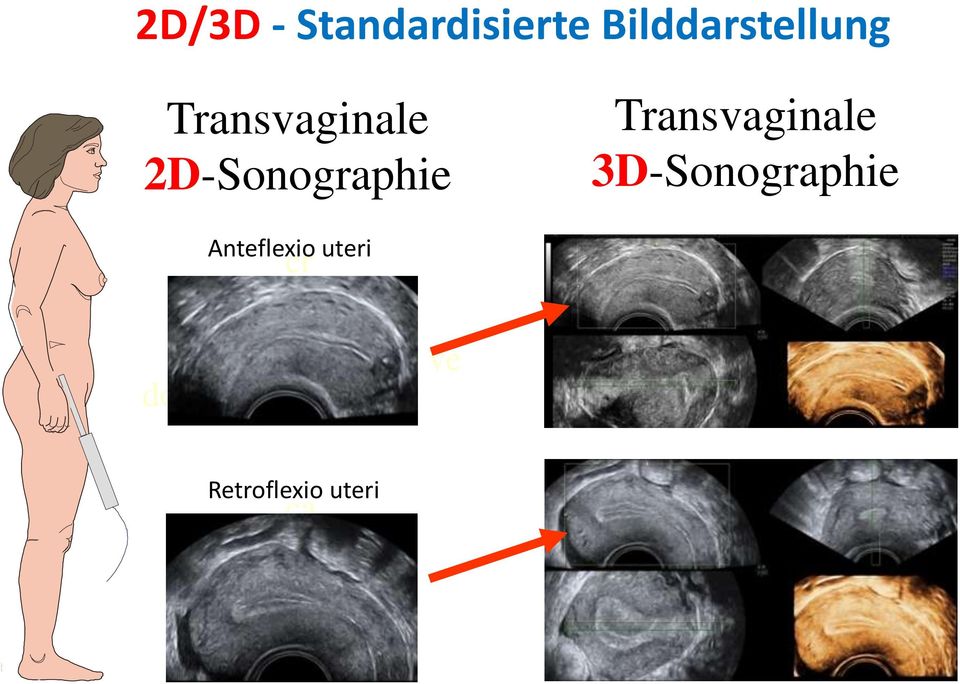 2D-Sonographie Transvaginale
