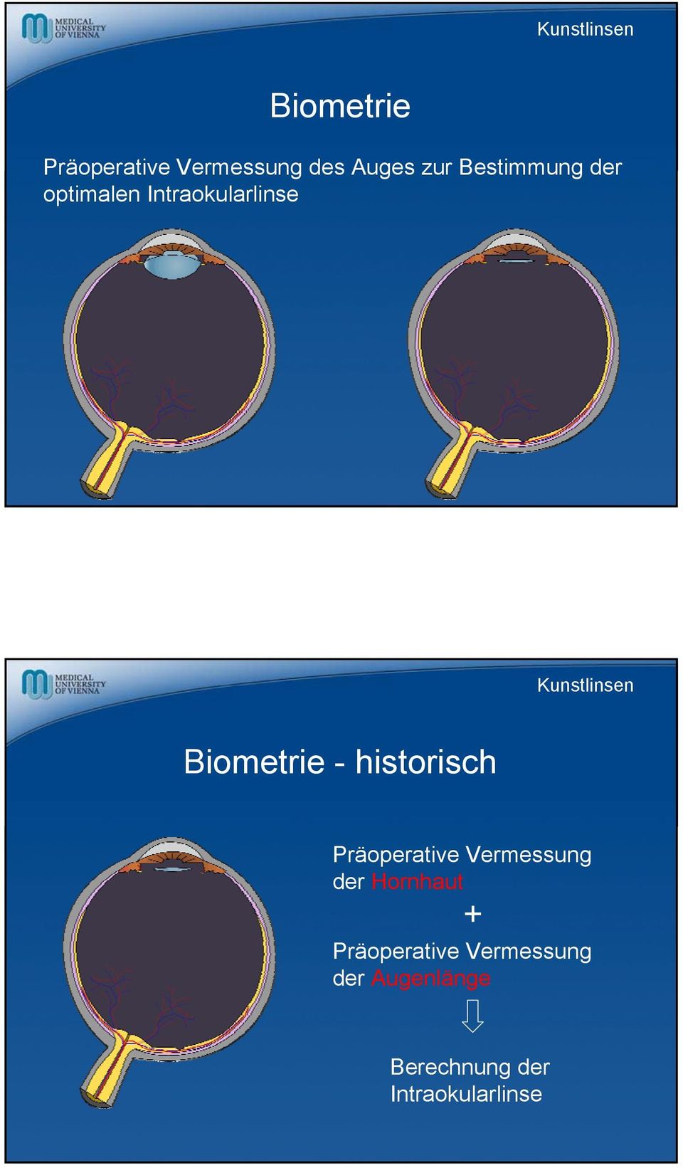 Biometrie - historisch Präoperative Vermessung der Hornhaut +