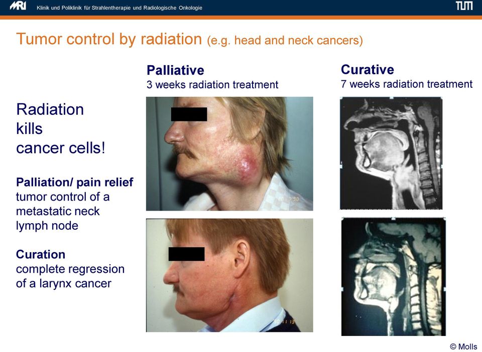 Palliative 3 weeks radiation treatment Curative 7 weeks radiation