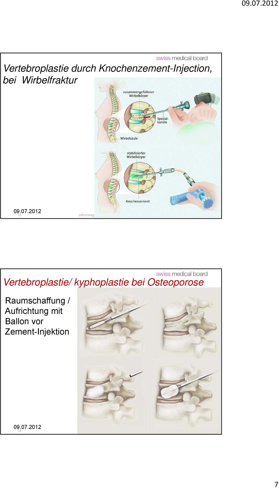 kyphoplastie bei Osteoporose Raumschaffung /