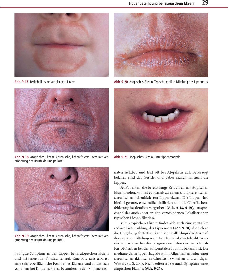 Chronische, lichenifizierte Form mit Vergröberung der Hautfelderung perioral. häufigste Symptom an den Lippen beim atopischen Ekzem und tritt meist im Kindesalter auf.