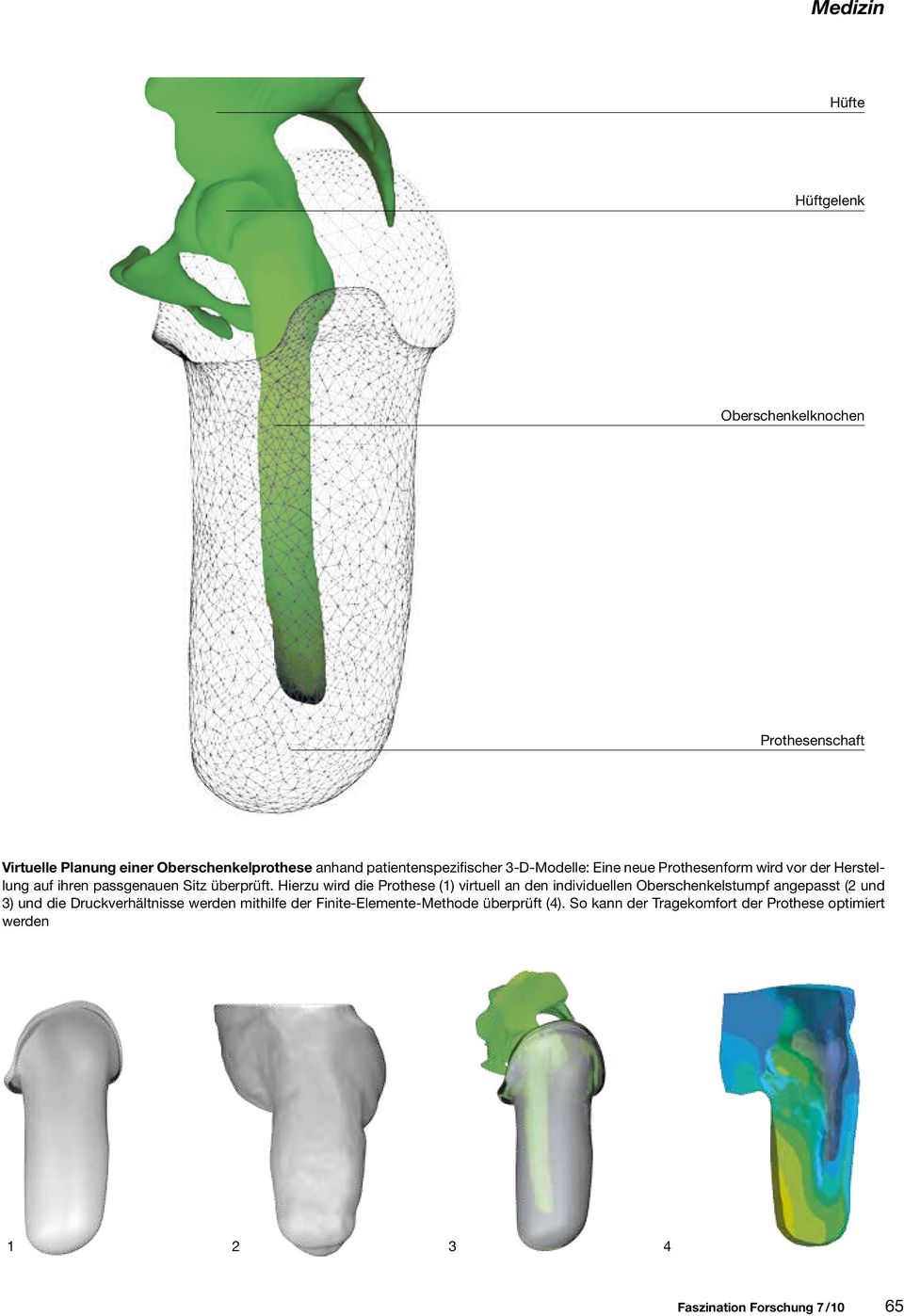 Hierzu wird die Prothese (1) virtuell an den individuellen Oberschenkelstumpf angepasst (2 und 3) und die Druckverhältnisse