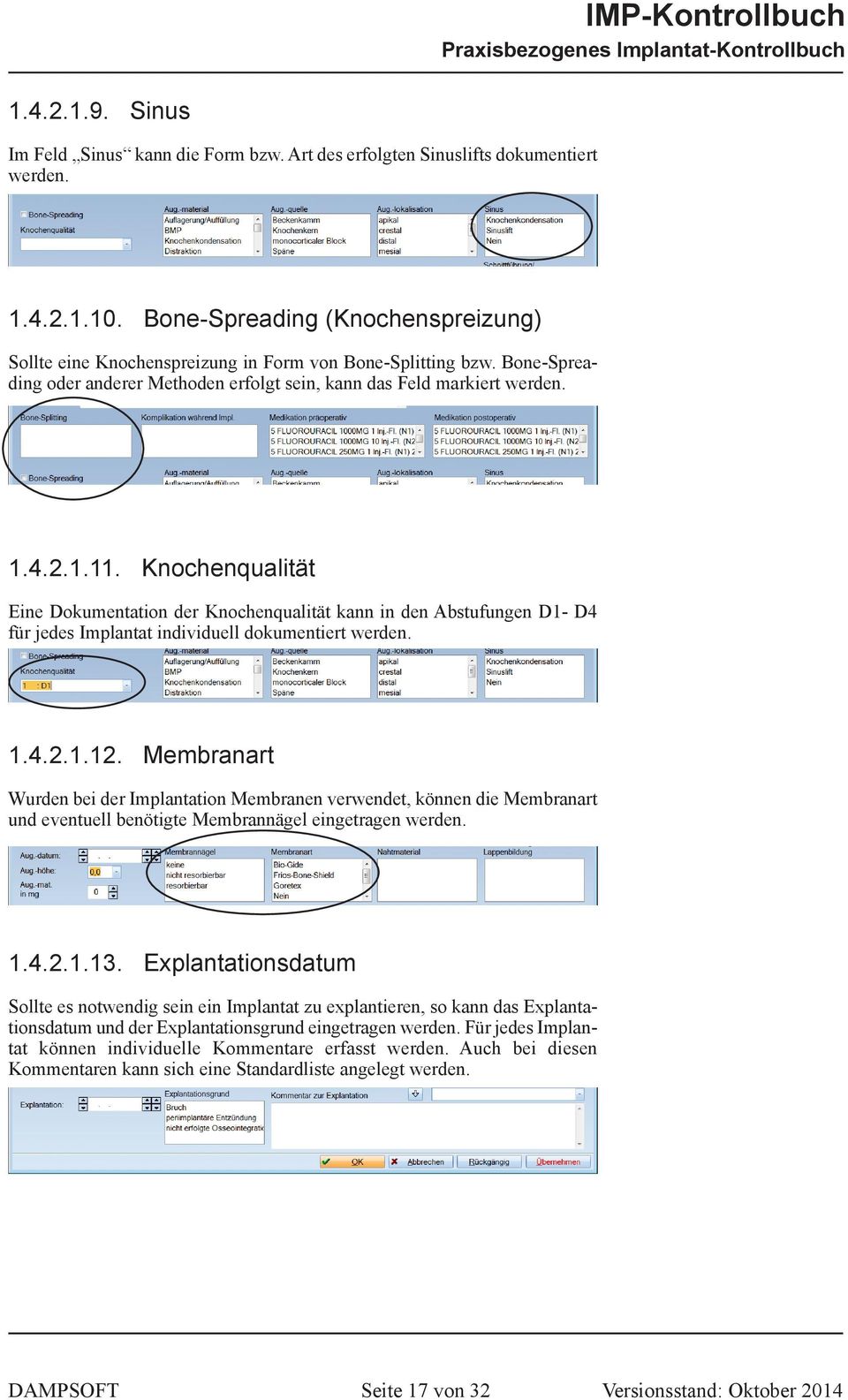 Knochenqualität Eine Dokumentation der Knochenqualität kann in den Abstufungen D1- D4 für jedes Implantat individuell dokumentiert werden. 1.4.2.1.12.