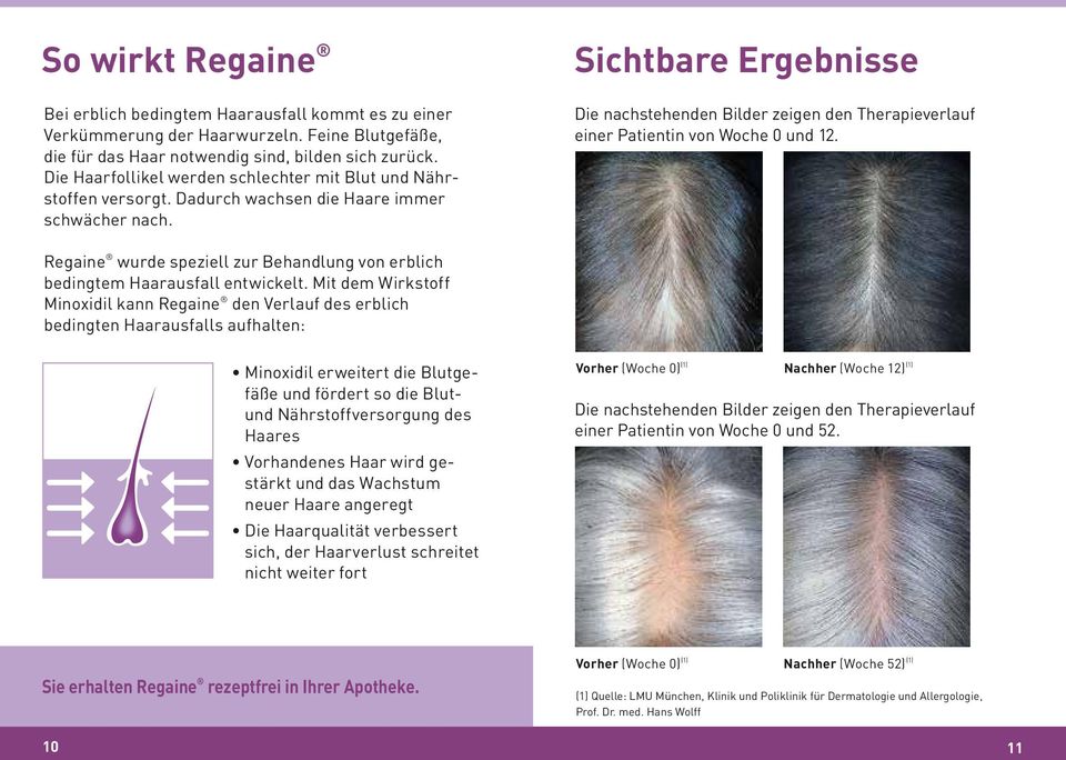Sichtbare Ergebnisse Die nachstehenden Bilder zeigen den Therapieverlauf einer Patientin von Woche 0 und 12. Regaine wurde speziell zur Behandlung von erblich bedingtem Haarausfall entwickelt.