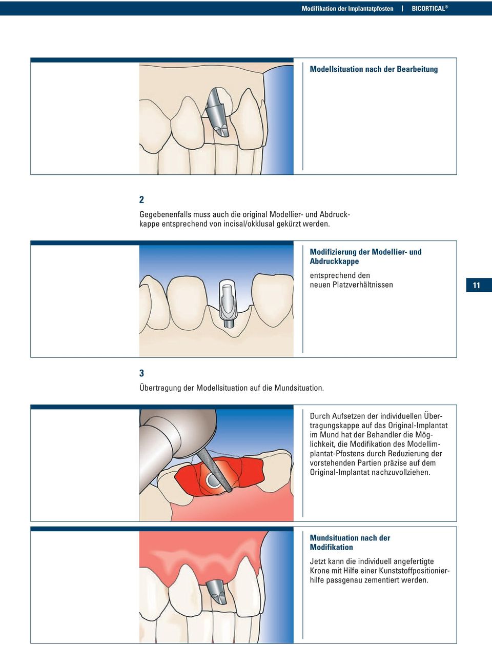 Durch Aufsetzen der individuellen Übertragungskappe auf das Original-Implantat im Mund hat der Behandler die Möglichkeit, die Modifikation des Modellimplantat-Pfostens durch Reduzierung der