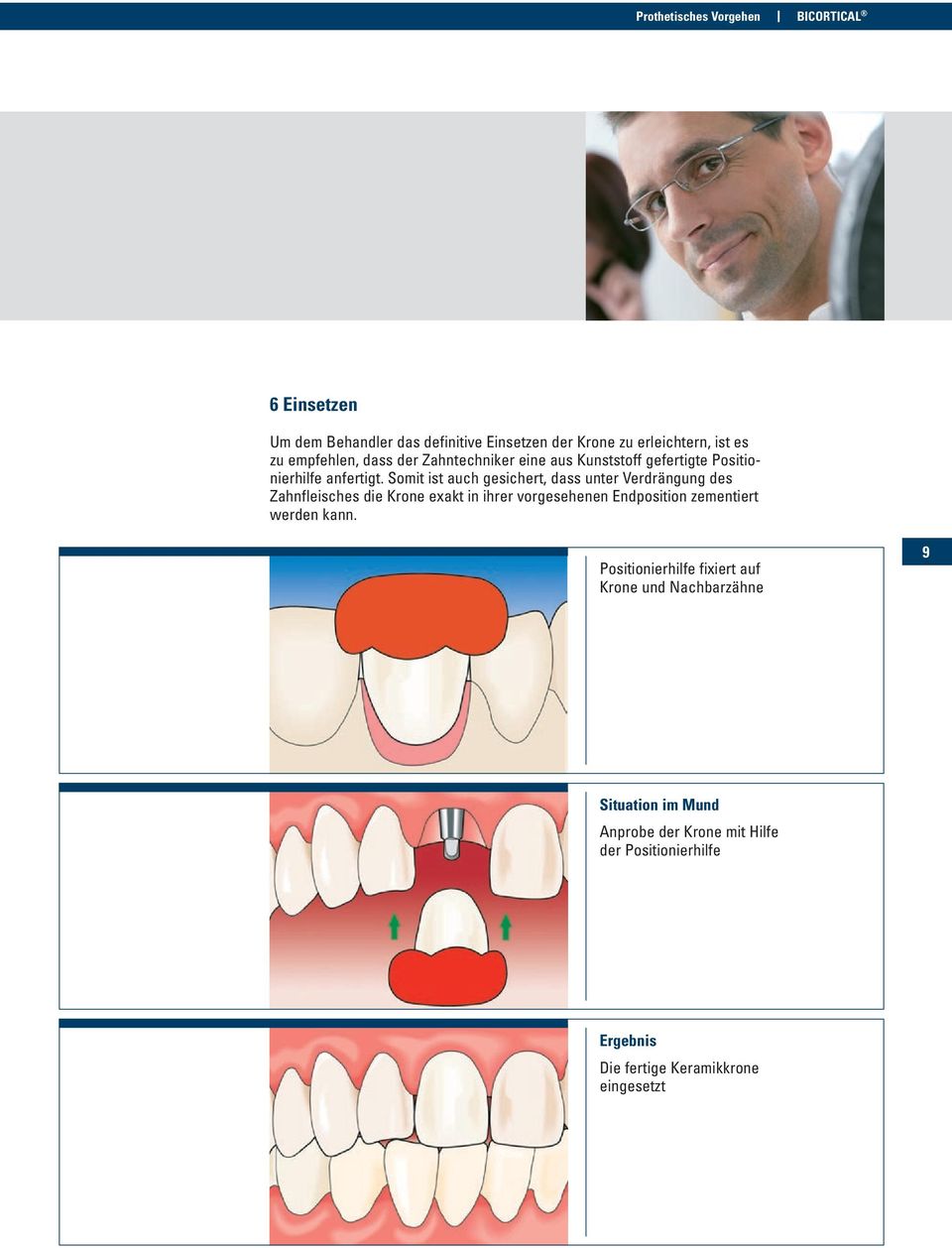 Somit ist auch gesichert, dass unter Verdrängung des Zahnfleisches die Krone exakt in ihrer vorgesehenen Endposition zementiert
