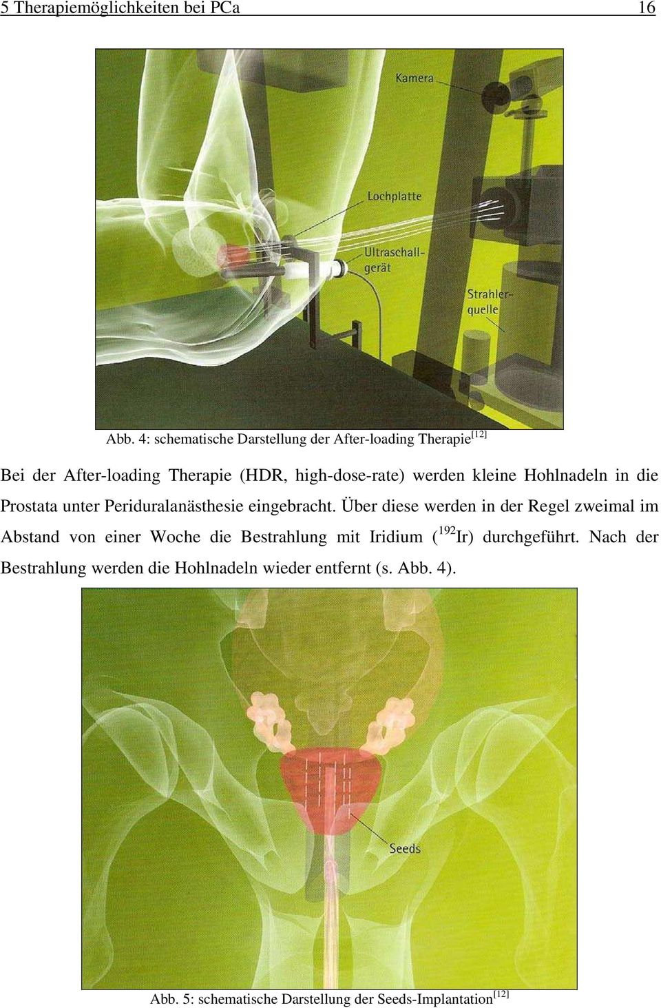 kleine Hohlnadeln in die Prostata unter Periduralanästhesie eingebracht.