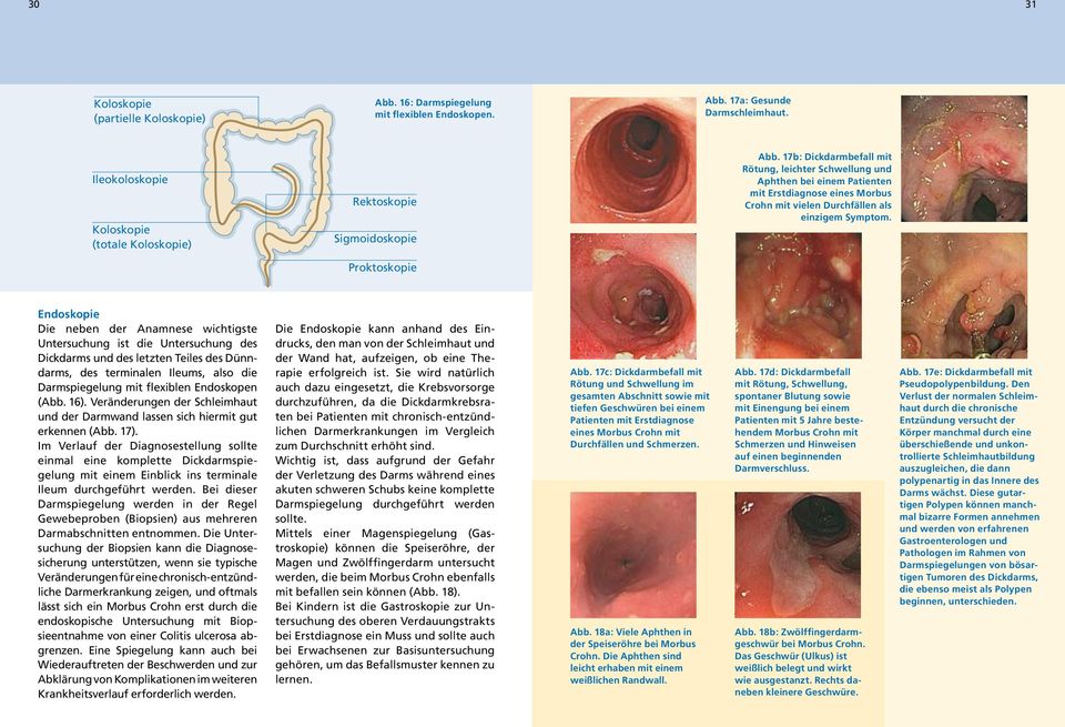17b: Dickdarmbefall mit Rötung, leichter Schwellung und Aphthen bei einem Patienten mit Erstdiagnose eines Morbus Crohn mit vielen Durchfällen als einzigem Symptom.