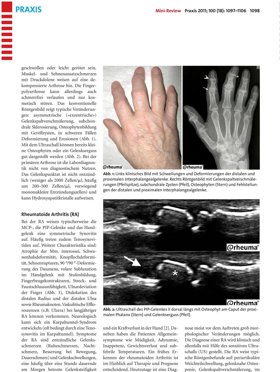 Das konventionelle Röntgenbild zeigt typische Veränderungen: asymmetrische («exzentrische») Gelenkspaltverschmälerung, subchondrale Sklerosierung, Osteophytenbildung mit Geröllzysten, in schweren