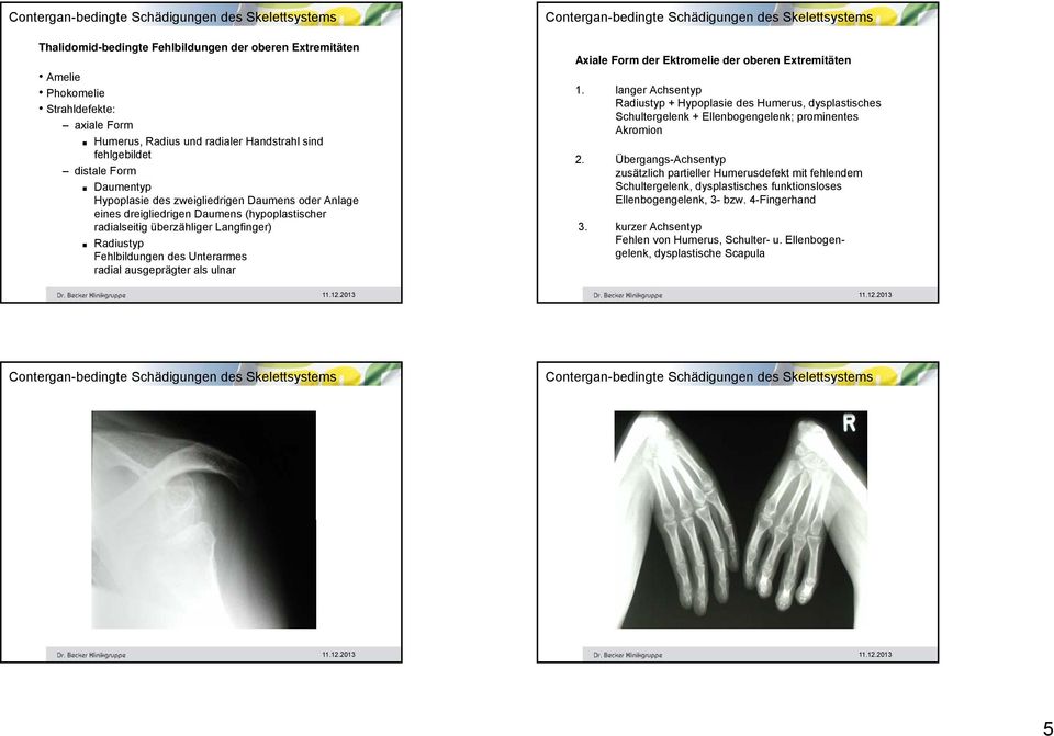 der Ektromelie der oberen Extremitäten 1. langer Achsentyp Radiustyp + Hypoplasie des Humerus, dysplastisches Schultergelenk + Ellenbogengelenk; prominentes Akromion 2.