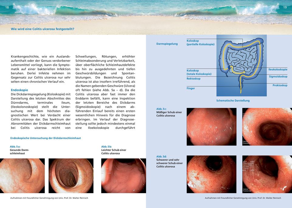 beruhen. Derlei Infekte nehmen im Gegensatz zur Colitis ulcerosa nur sehr selten einen chronischen Verlauf ein.