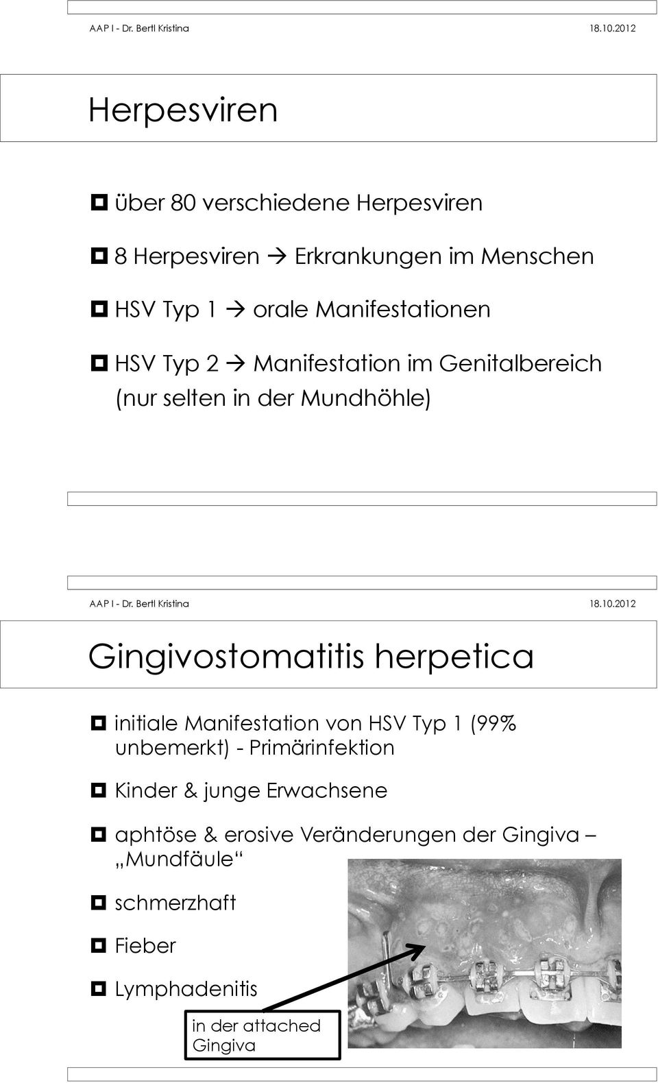 Manifestation im Genitalbereich (nur selten in der Mundhöhle) Gingivostomatitis herpetica!