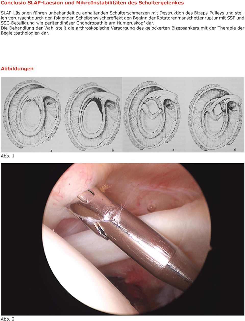 der Rotatorenmanschettenruptur mit SSP und SSC-Beteiligung wie peritendinöser Chondropathie am Humeruskopf dar.