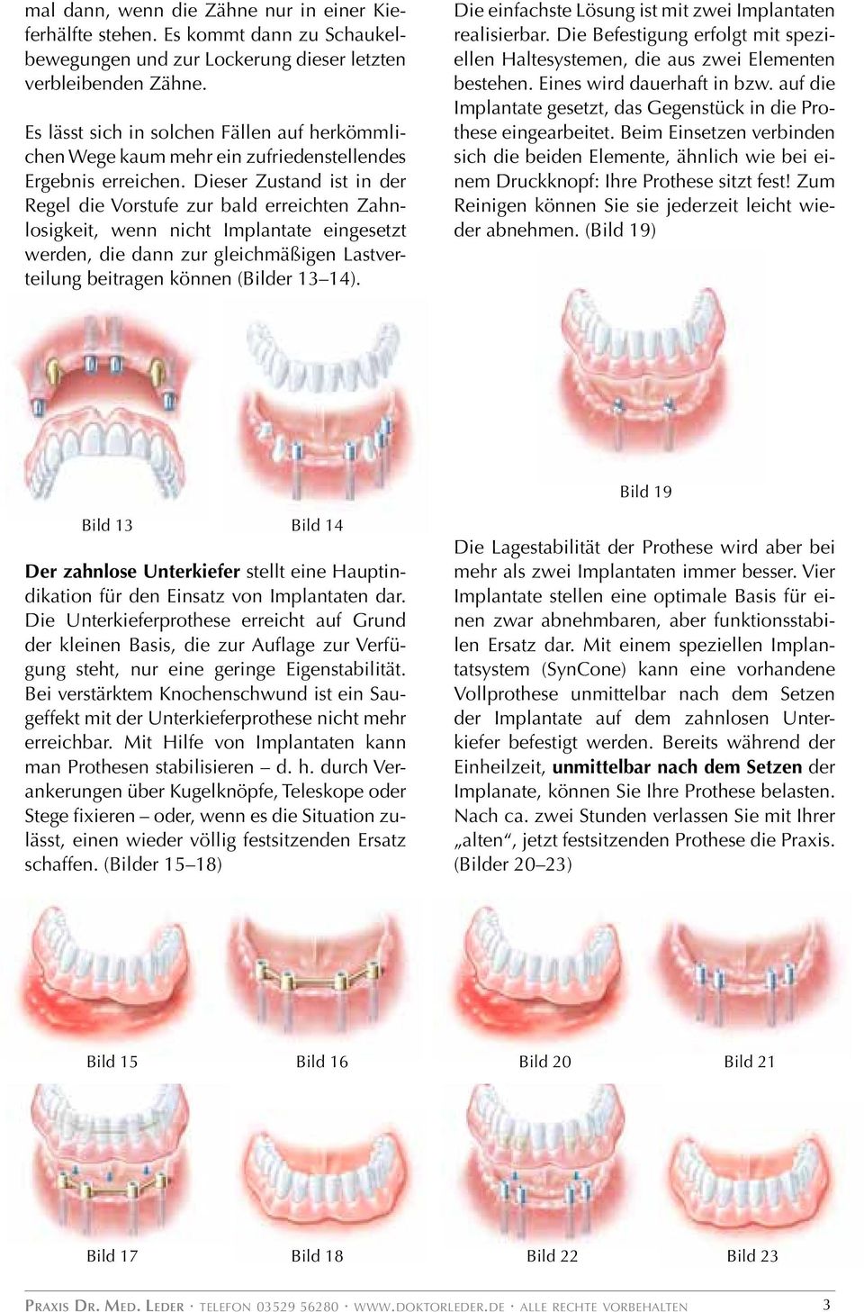 Dieser Zustand ist in der Regel die Vorstufe zur bald erreichten Zahnlosigkeit, wenn nicht Implantate eingesetzt werden, die dann zur gleichmäßigen Lastverteilung beitragen können (Bilder 13 14).